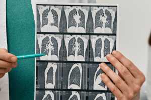 Advanced Mesothelioma Life Expectancy in 2024 : Comprehensive Insights