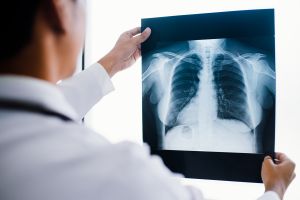 Can a Chest X-Ray Show Mesothelioma?