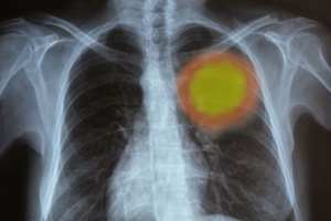 How does mesothelioma develop?