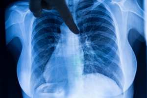 How early can you detect mesothelioma? : Early Diagnosis Guide