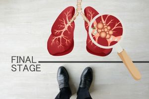 What happens in the Final Stages of Mesothelioma : Symptoms, Timeline and Prognosis