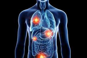 What organs are affected by mesothelioma