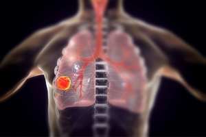 Where does Mesothelioma affect? Organs Most Affected